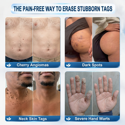【 💎Last Day Promotion 70% OFF💎】🇺🇸𝐇𝐞𝒂𝒍𝗿𝗶𝙯𝙚®2-in-1 Microneedle & Hydrocolloid Patch| Removes Raised Moles, Acne, Flat Warts & Skin Tags | Helps Improve Wrinkles, Scars & Blemishes | Invisible Patches for Face & Body