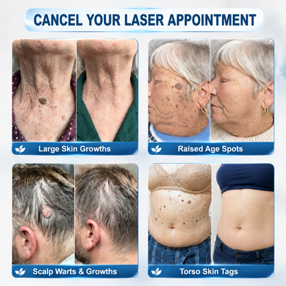 【 💎Last Day Promotion 70% OFF💎】🇺🇸𝐇𝐞𝒂𝒍𝗿𝗶𝙯𝙚®2-in-1 Microneedle & Hydrocolloid Patch| Removes Raised Moles, Acne, Flat Warts & Skin Tags | Helps Improve Wrinkles, Scars & Blemishes | Invisible Patches for Face & Body
