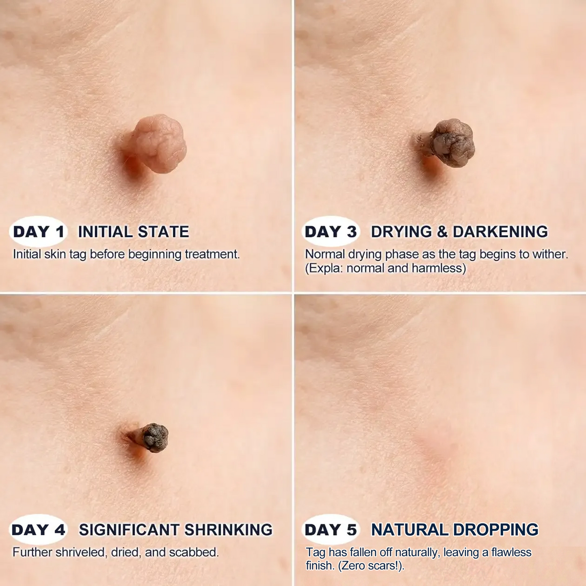【 💎Last Day Promotion 70% OFF💎】🇺🇸𝐇𝐞𝒂𝒍𝗿𝗶𝙯𝙚®2-in-1 Microneedle & Hydrocolloid Patch| Removes Raised Moles, Acne, Flat Warts & Skin Tags | Helps Improve Wrinkles, Scars & Blemishes | Invisible Patches for Face & Body