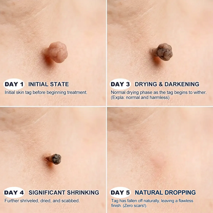 【 💎Last Day Promotion 70% OFF💎】🇺🇸𝐇𝐞𝒂𝒍𝗿𝗶𝙯𝙚®2-in-1 Microneedle & Hydrocolloid Patch| Removes Raised Moles, Acne, Flat Warts & Skin Tags | Helps Improve Wrinkles, Scars & Blemishes | Invisible Patches for Face & Body